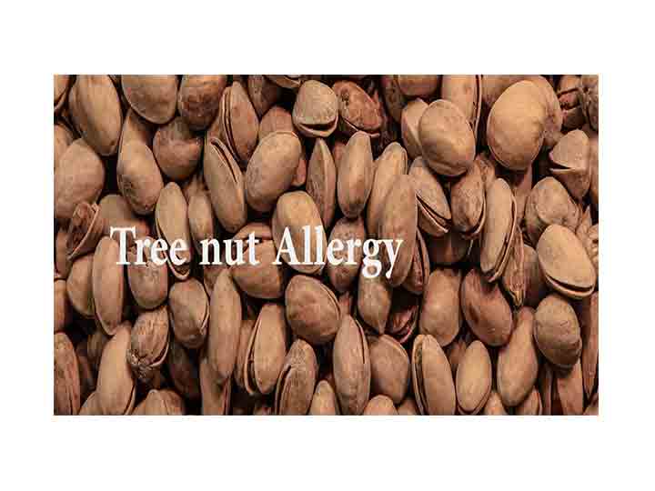 Tree nut Allergy